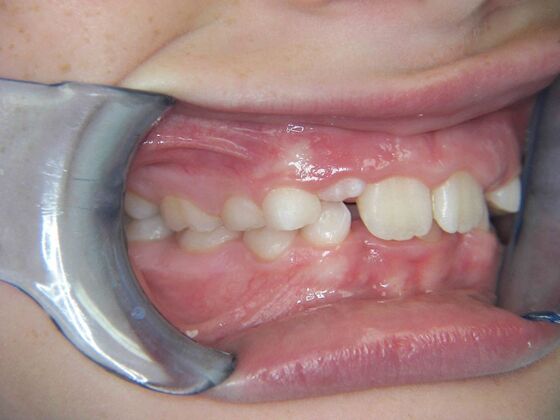 Orthodontics: Case 2 - Before
