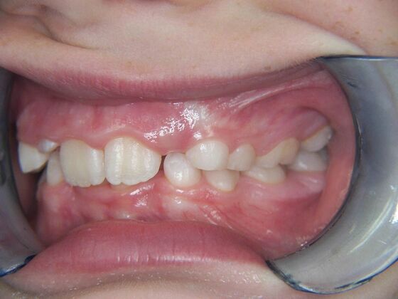 Orthodontics: Case 2 - Before