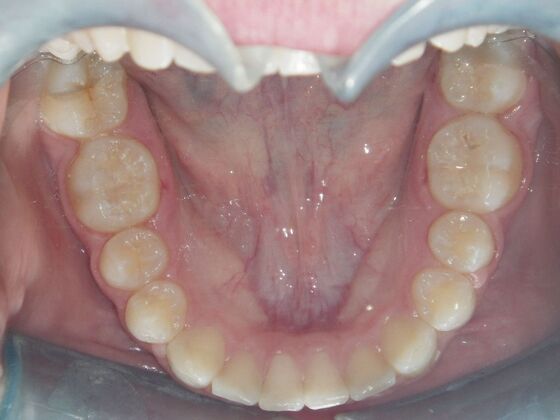 Orthodontics: Case 2 - After