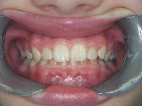Orthodontics: Case 2 - Before