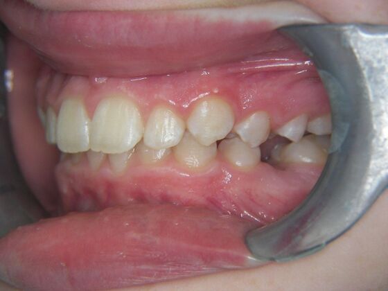 Orthodontics: Case 2 - Before