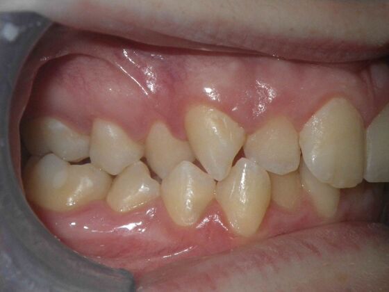Orthodontics: Case 4 - Before