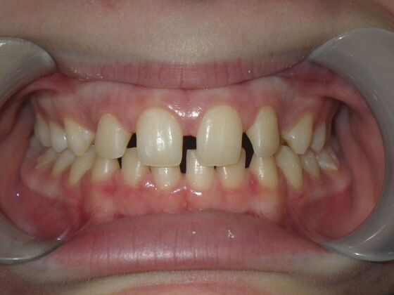 Orthodontics: Case 5 - Before