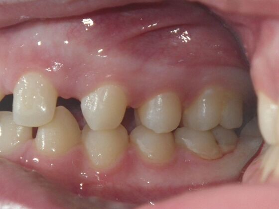 Orthodontics: Case 5 - Before