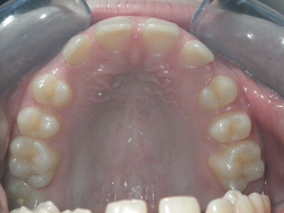 Orthodontics: Case 5 - Before