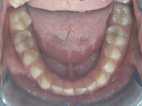 Orthodontics: Case 5 - Before