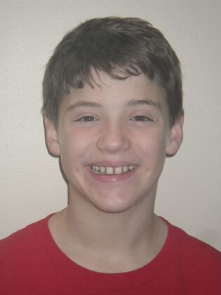 Orthodontics: Case 5 - Before