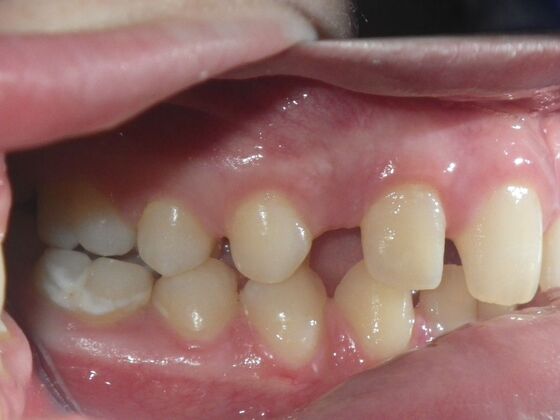 Orthodontics: Case 5 - Before