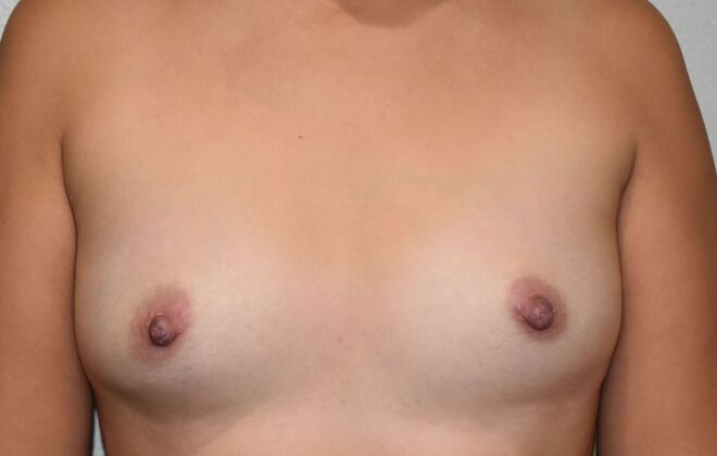 Breast Augmentation Case 746 - Before