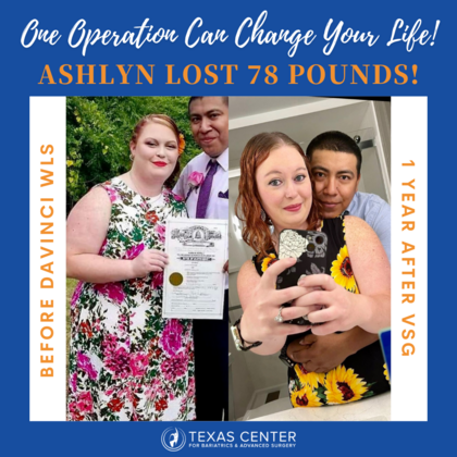 Surgiversary Celebrations Happy 1 Year Surgiversary Ashlyn!