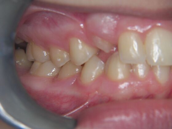 Orthodontics: Case 7 - Before
