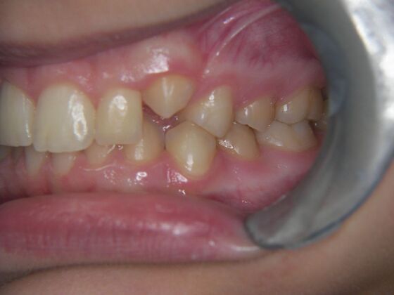 Orthodontics: Case 7 - Before