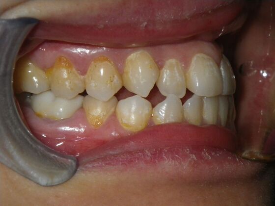 Orthodontics: Case 9 - Before