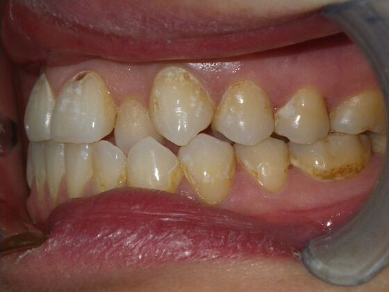 Orthodontics: Case 9 - Before
