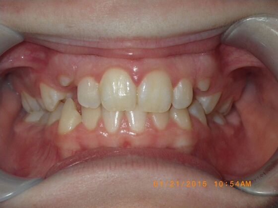 Orthodontics: Case 10 - Before