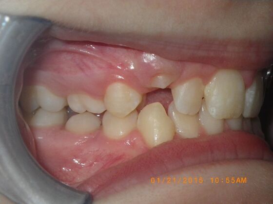 Orthodontics: Case 10 - Before
