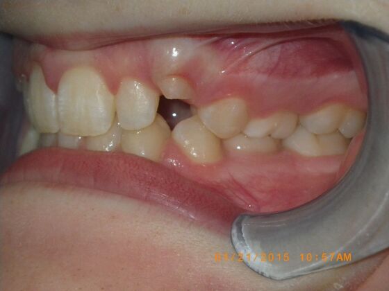 Orthodontics: Case 10 - Before