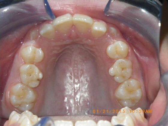 Orthodontics: Case 10 - Before