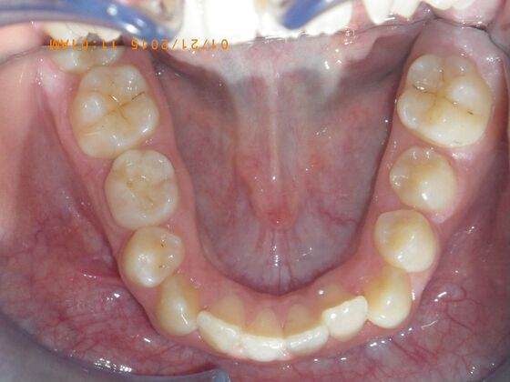 Orthodontics: Case 10 - Before