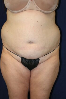 LIPOSUCTION 360*: Case 1 - Before