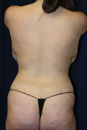 LIPOSUCTION 360*: Case 1 - After