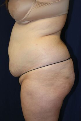 LIPOSUCTION 360*: Case 1 - Before