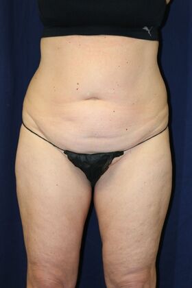 LIPOSUCTION 360*: Case 2 - Before