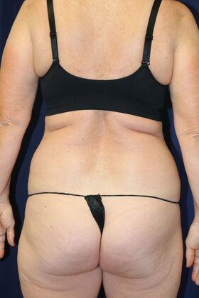 LIPOSUCTION 360*: Case 2 - Before