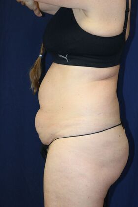LIPOSUCTION 360*: Case 2 - Before