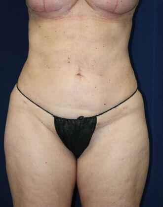 LIPOSUCTION 360*: Case 2 - After
