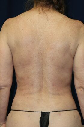 LIPOSUCTION 360*: Case 2 - After