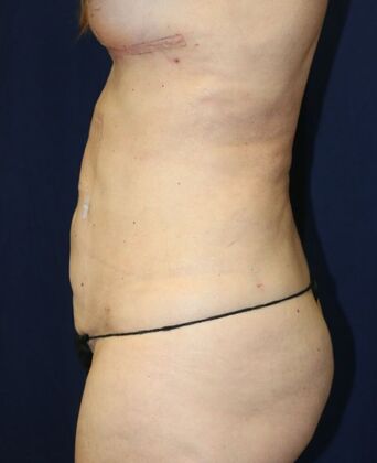 LIPOSUCTION 360*: Case 2 - After