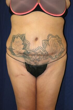 LIPOSUCTION 360*: Case 4 - Before