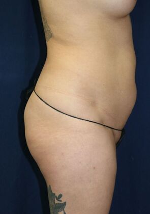 LIPOSUCTION 360*: Case 5 - Before