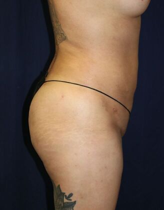 LIPOSUCTION 360*: Case 5 - After