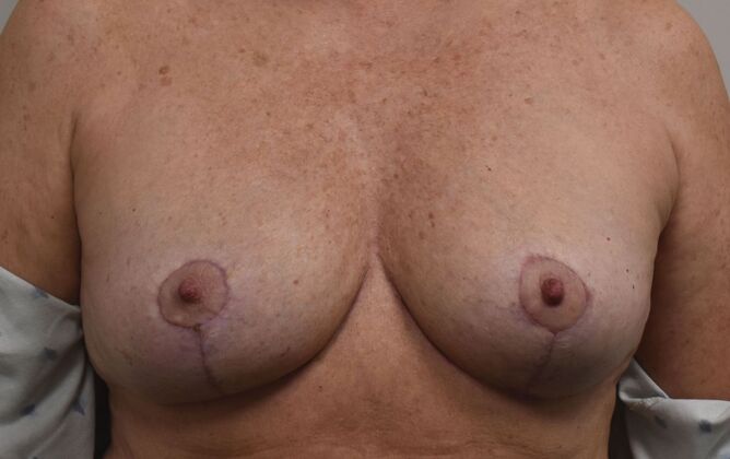 Breast Implant Removal: Case 32 - After