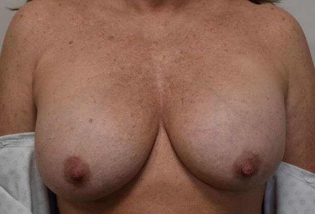 Breast Implant Removal: Case 32 - Before