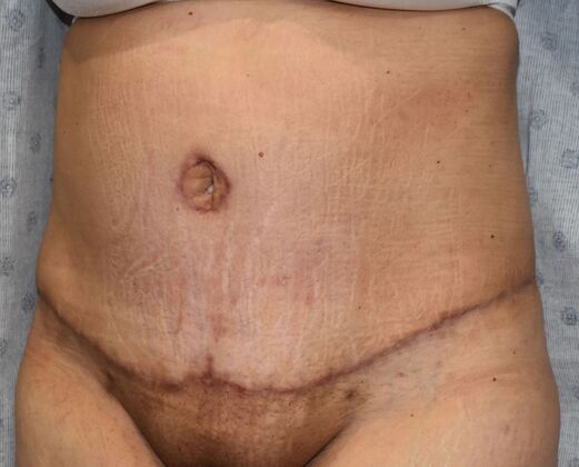 Tummy Tuck (Abdominoplasty): Case 414 - After
