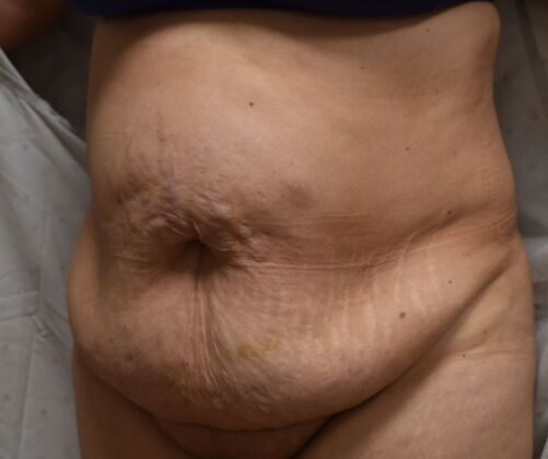 Tummy Tuck (Abdominoplasty): Case 414 - Before