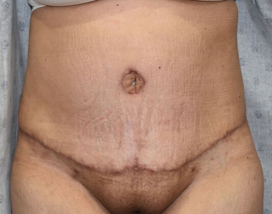 Tummy Tuck (Abdominoplasty): Case 414 - After