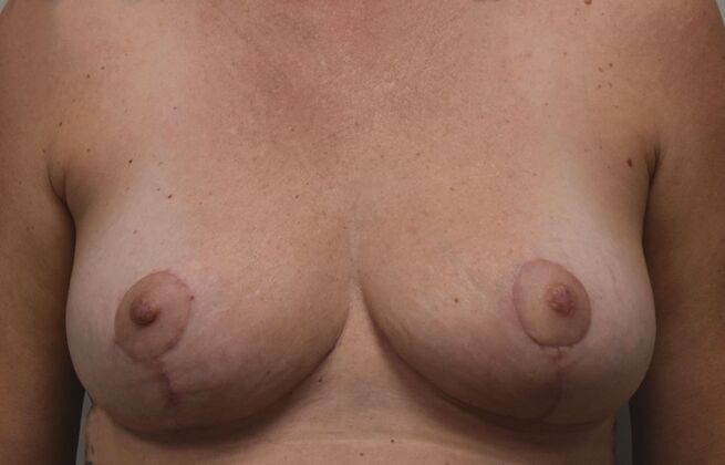 Breast Lift (Mastopexy) Case 170 - After