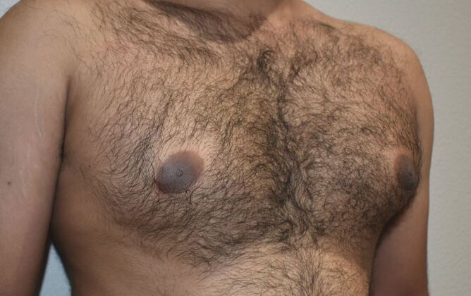 Gynecomastia Case 5 - Before