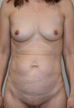 Mommy Makeover Case 273 - Before