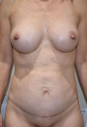 Mommy Makeover Case 273 - After