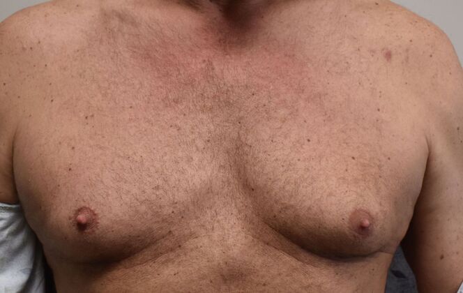 Gynecomastia Case 6 - Before