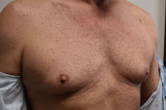 Gynecomastia: Case 6 - Before