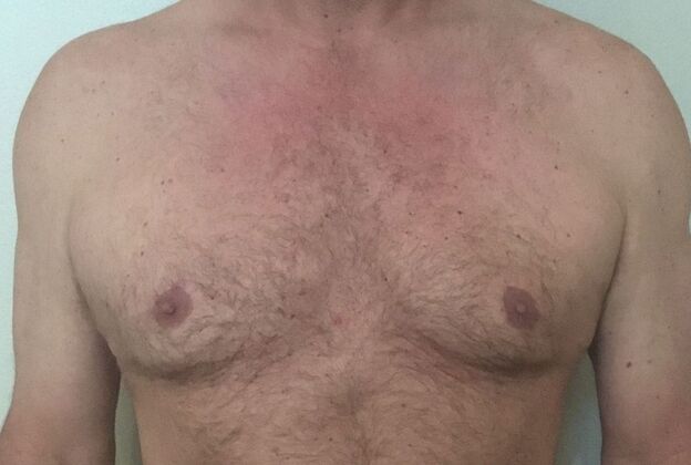 Gynecomastia Case 6 - After