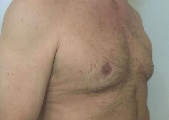 Gynecomastia: Case 6 - After