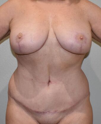 Mommy Makeover Case 274 - After