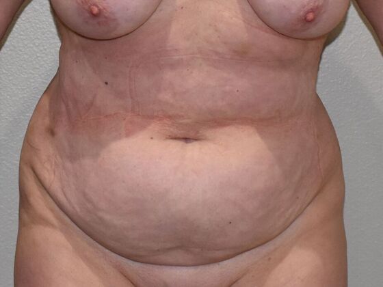 Tummy Tuck (Abdominoplasty): Case 422 - Before